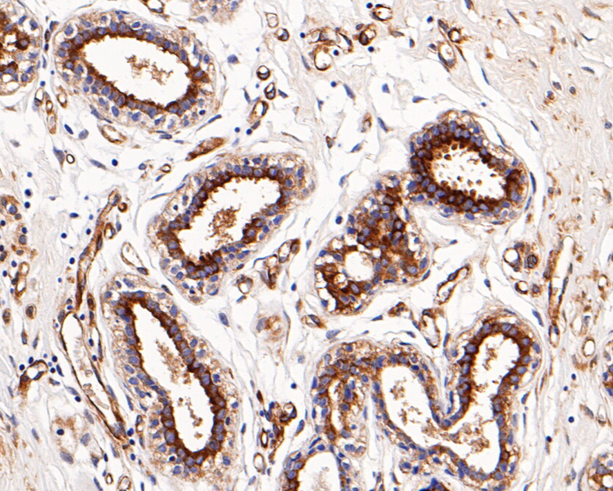 Immunohistochemical analysis of paraffin-embedded human breast carcinoma tissue with Mouse anti-HSP27 antibody (M1505-3) at 1/1,000 dilution.<br />
<br />
The section was pre-treated using heat mediated antigen retrieval with Tris-EDTA buffer (pH 9.0) for 20 minutes. The tissues were blocked in 1% BSA for 20 minutes at room temperature, washed with ddH2O and PBS, and then probed with the primary antibody (M1505-3) at 1/1.000 dilution for 1 hour at room temperature. The detection was performed using an HRP conjugated compact polymer system. DAB was used as the chromogen. Tissues were counterstained with hematoxylin and mounted with DPX.