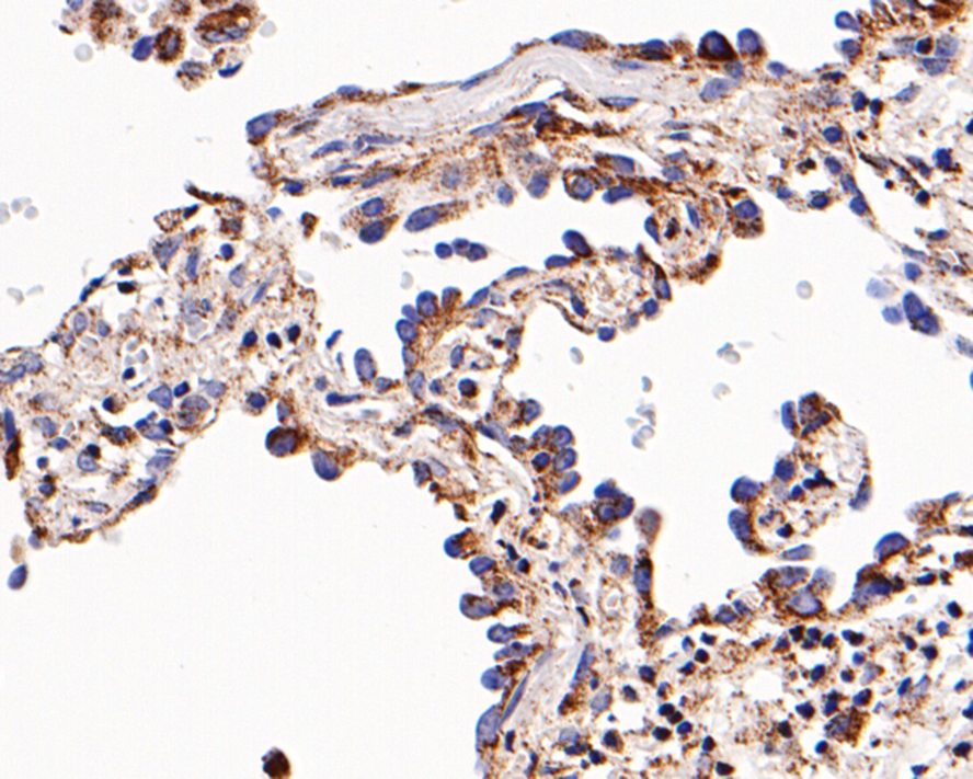 Immunohistochemical analysis of paraffin-embedded human lung cancerr tissue with Mouse anti-HSP60 antibody (M1007-9) at 1/400 dilution.<br />
<br />
The section was pre-treated using heat mediated antigen retrieval with Tris-EDTA buffer (pH 9.0) for 20 minutes. The tissues were blocked in 1% BSA for 20 minutes at room temperature, washed with ddH2O and PBS, and then probed with the primary antibody (M1007-9) at 1/400 dilution for 1 hour at room temperature. The detection was performed using an HRP conjugated compact polymer system. DAB was used as the chromogen. Tissues were counterstained with hematoxylin and mounted with DPX.