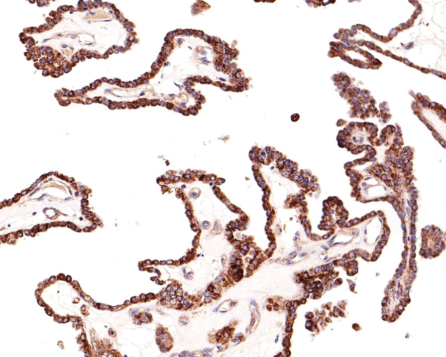 Immunohistochemical analysis of paraffin-embedded human thyroid carcinoma tissue with Rabbit anti-ADAM10 antibody (ET1703-60) at 1/100 dilution.<br />
<br />
The section was pre-treated using heat mediated antigen retrieval with Tris-EDTA buffer (pH 9.0) for 20 minutes. The tissues were blocked in 1% BSA for 20 minutes at room temperature, washed with ddH2O and PBS, and then probed with the primary antibody (ET1703-60) at 1/100 dilution for 1 hour at room temperature. The detection was performed using an HRP conjugated compact polymer system. DAB was used as the chromogen. Tissues were counterstained with hematoxylin and mounted with DPX.