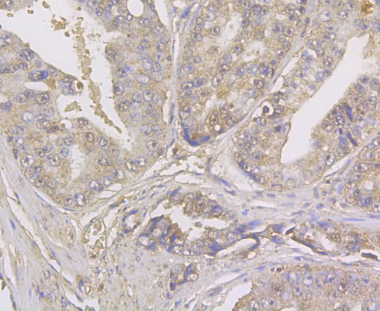 Immunohistochemical analysis of paraffin-embedded human prostate cancer tissue using anti-Kir6.2 antibody. The section was pre-treated using heat mediated antigen retrieval with Tris-EDTA buffer (pH 8.0-8.4) for 20 minutes.The tissues were blocked in 5% BSA for 30 minutes at room temperature, washed with ddH2O and PBS, and then probed with the antibody (ER1803-98) at 1/50 dilution, for 30 minutes at room temperature and detected using an HRP conjugated compact polymer system. DAB was used as the chromogen. Counter stained with hematoxylin and mounted with DPX.