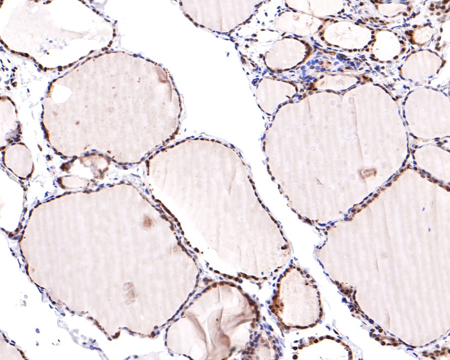 Immunohistochemical analysis of paraffin-embedded human thyroid carcinoma tissue with Mouse anti-GAPDH antibody (M1310-2) at 1/600 dilution.<br />
<br />
The section was pre-treated using heat mediated antigen retrieval with sodium citrate buffer (pH 6.0) for 2 minutes. The tissues were blocked in 1% BSA for 20 minutes at room temperature, washed with ddH2O and PBS, and then probed with the primary antibody (M1310-2) at 1/600 dilution for 1 hour at room temperature. The detection was performed using an HRP conjugated compact polymer system. DAB was used as the chromogen. Tissues were counterstained with hematoxylin and mounted with DPX.