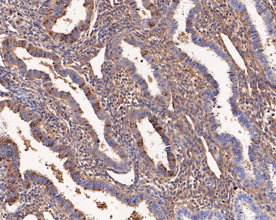 Immunohistochemical analysis of paraffin-embedded human endometrium tissue with Mouse anti-Alpha-2-macroglobulin antibody (M1510-24) at 1/200 dilution.<br />
<br />
The section was pre-treated using heat mediated antigen retrieval with Tris-EDTA buffer (pH 9.0) for 20 minutes. The tissues were blocked in 1% BSA for 20 minutes at room temperature, washed with ddH2O and PBS, and then probed with the primary antibody (M1510-24) at 1/200 dilution for 1 hour at room temperature. The detection was performed using an HRP conjugated compact polymer system. DAB was used as the chromogen. Tissues were counterstained with hematoxylin and mounted with DPX.