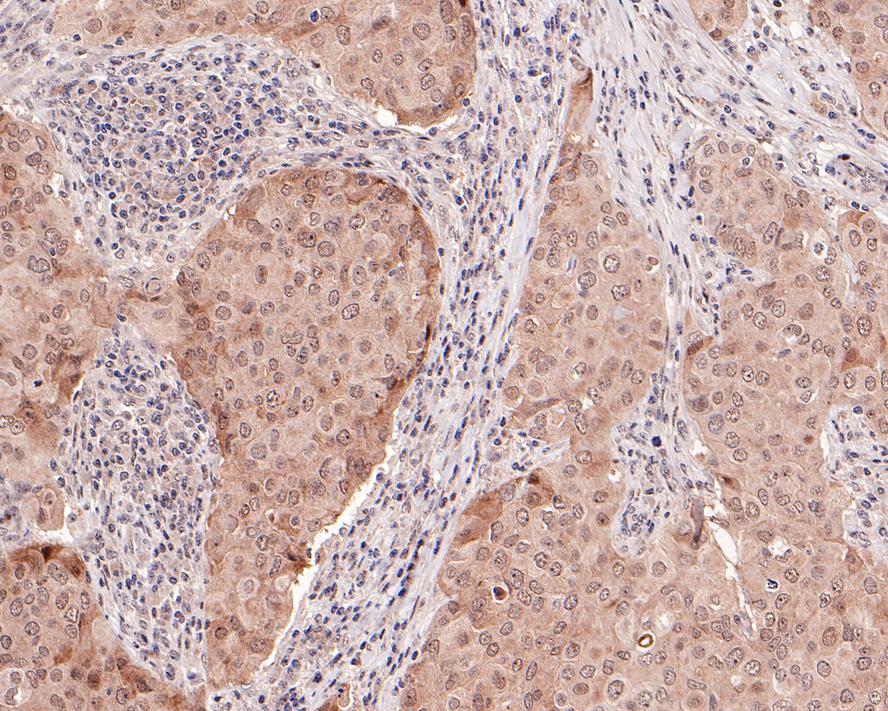Immunohistochemical analysis of paraffin-embedded human breast carcinoma tissue with Rabbit anti-Phospho-AKT1 (T450) antibody (ET1612-73) at 1/50 dilution.<br />
<br />
The section was pre-treated using heat mediated antigen retrieval with Tris-EDTA buffer (pH 9.0) for 20 minutes. The tissues were blocked in 1% BSA for 20 minutes at room temperature, washed with ddH2O and PBS, and then probed with the primary antibody (ET1612-73) at 1/50 dilution for 1 hour at room temperature. The detection was performed using an HRP conjugated compact polymer system. DAB was used as the chromogen. Tissues were counterstained with hematoxylin and mounted with DPX.