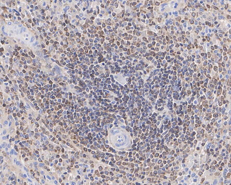 Immunohistochemical analysis of paraffin-embedded human B-cell lymphoma tissue with Rabbit anti-Bcl-2 antibody (ET1702-53) at 1/5,000 dilution.<br />
<br />
The section was pre-treated using heat mediated antigen retrieval with Tris-EDTA buffer (pH 9.0) for 20 minutes. The tissues were blocked in 1% BSA for 20 minutes at room temperature, washed with ddH2O and PBS, and then probed with the primary antibody (ET1702-53) at 1/5,000 dilution for 1 hour at room temperature. The detection was performed using an HRP conjugated compact polymer system. DAB was used as the chromogen. Tissues were counterstained with hematoxylin and mounted with DPX.