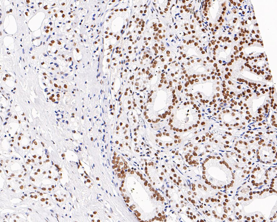 Immunohistochemical analysis of paraffin-embedded human prostate carcinoma tissue with Mouse anti-DNA-PKcs/PRKDC antibody (M1204-6) at 1/500 dilution.<br />
<br />
The section was pre-treated using heat mediated antigen retrieval with sodium citrate buffer (pH 6.0) for 2 minutes. The tissues were blocked in 1% BSA for 20 minutes at room temperature, washed with ddH2O and PBS, and then probed with the primary antibody (M1204-6) at 1/500 dilution for 1 hour at room temperature. The detection was performed using an HRP conjugated compact polymer system. DAB was used as the chromogen. Tissues were counterstained with hematoxylin and mounted with DPX.