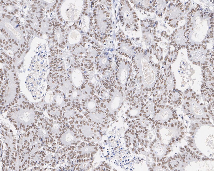 Immunohistochemical analysis of paraffin-embedded human colon cancer tissue with Mouse anti-DNA-PKcs/PRKDC antibody (M1204-6) at 1/500 dilution.<br />
<br />
The section was pre-treated using heat mediated antigen retrieval with sodium citrate buffer (pH 6.0) for 2 minutes. The tissues were blocked in 1% BSA for 20 minutes at room temperature, washed with ddH2O and PBS, and then probed with the primary antibody (M1204-6) at 1/500 dilution for 1 hour at room temperature. The detection was performed using an HRP conjugated compact polymer system. DAB was used as the chromogen. Tissues were counterstained with hematoxylin and mounted with DPX.