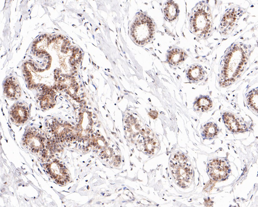 Immunohistochemical analysis of paraffin-embedded human breast tissue with Rabbit anti-ESR1 antibody (0803-1) at 1/100 dilution.<br />
<br />
The section was pre-treated using heat mediated antigen retrieval with sodium citrate buffer (pH 6.0) for 2 minutes. The tissues were blocked in 1% BSA for 20 minutes at room temperature, washed with ddH2O and PBS, and then probed with the primary antibody (0803-1) at 1/100 dilution for 1 hour at room temperature. The detection was performed using an HRP conjugated compact polymer system. DAB was used as the chromogen. Tissues were counterstained with hematoxylin and mounted with DPX.