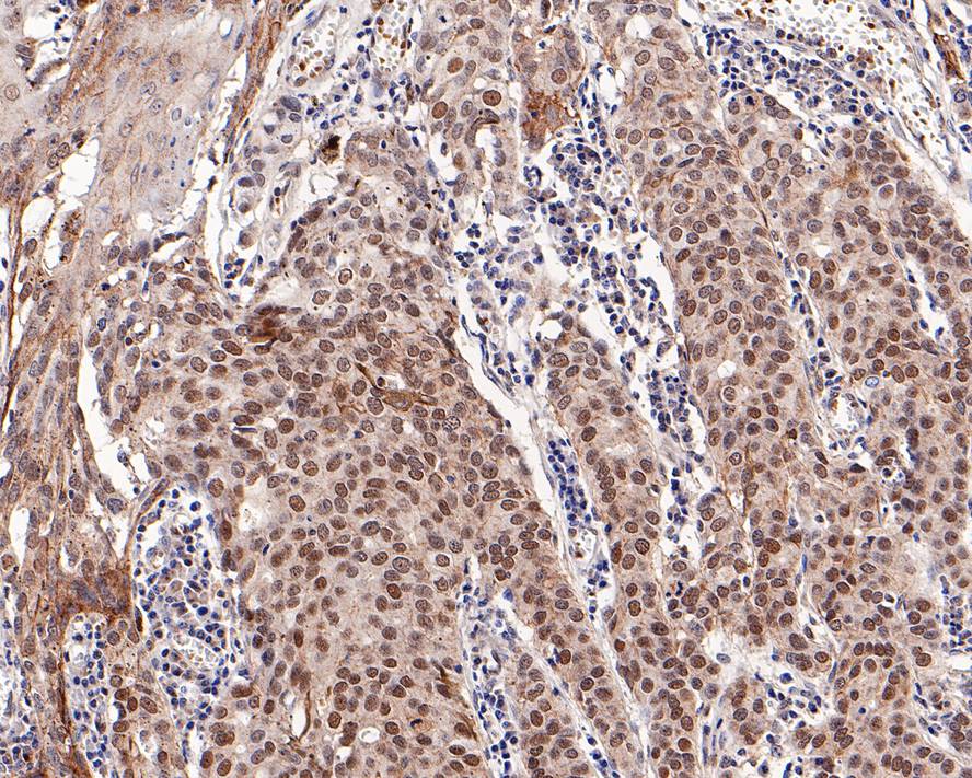Immunohistochemical analysis of paraffin-embedded human breast carcinoma tissue with Rabbit anti-RING2 antibody (ET7107-07) at 1/200 dilution.<br />
<br />
The section was pre-treated using heat mediated antigen retrieval with Tris-EDTA buffer (pH 9.0) for 20 minutes. The tissues were blocked in 1% BSA for 20 minutes at room temperature, washed with ddH2O and PBS, and then probed with the primary antibody (ET7107-07) at 1/200 dilution for 1 hour at room temperature. The detection was performed using an HRP conjugated compact polymer system. DAB was used as the chromogen. Tissues were counterstained with hematoxylin and mounted with DPX.