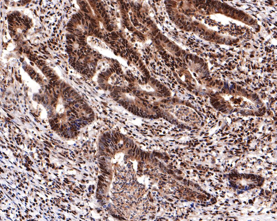 Immunohistochemical analysis of paraffin-embedded human colon carcinoma tissue with Mouse anti-GAPDH antibody (M1310-2) at 1/600 dilution.<br />
<br />
The section was pre-treated using heat mediated antigen retrieval with sodium citrate buffer (pH 6.0) for 2 minutes. The tissues were blocked in 1% BSA for 20 minutes at room temperature, washed with ddH2O and PBS, and then probed with the primary antibody (M1310-2) at 1/600 dilution for 1 hour at room temperature. The detection was performed using an HRP conjugated compact polymer system. DAB was used as the chromogen. Tissues were counterstained with hematoxylin and mounted with DPX.