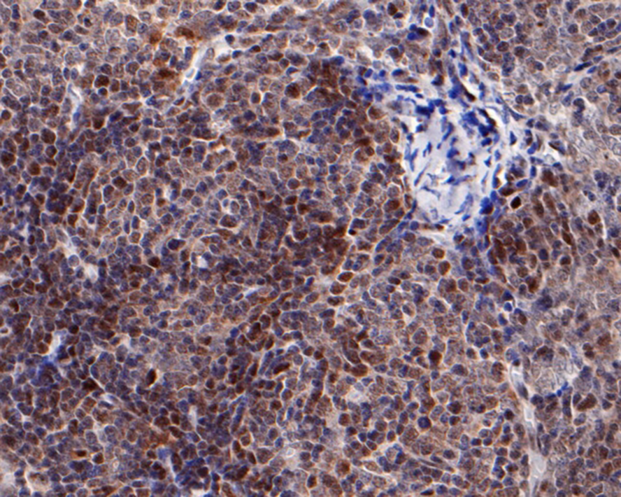 Immunohistochemical analysis of paraffin-embedded human thymus tissue with Rabbit anti-Autoimmune regulator (AIRE) antibody (R1107-1) at 1/50 dilution.<br />
<br />
The section was pre-treated using heat mediated antigen retrieval with sodium citrate buffer (pH 6.0) for 2 minutes. The tissues were blocked in 1% BSA for 20 minutes at room temperature, washed with ddH2O and PBS, and then probed with the primary antibody (R1107-1) at 1/50 dilution for 1 hour at room temperature. The detection was performed using an HRP conjugated compact polymer system. DAB was used as the chromogen. Tissues were counterstained with hematoxylin and mounted with DPX.