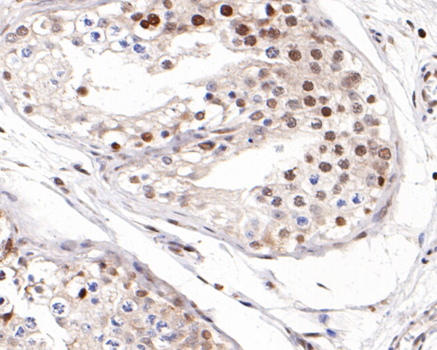 Immunohistochemical analysis of paraffin-embedded human testis tissue with Rabbit anti-Autoimmune regulator (AIRE) antibody (R1107-1) at 1/50 dilution.<br />
<br />
The section was pre-treated using heat mediated antigen retrieval with sodium citrate buffer (pH 6.0) for 2 minutes. The tissues were blocked in 1% BSA for 20 minutes at room temperature, washed with ddH2O and PBS, and then probed with the primary antibody (R1107-1) at 1/50 dilution for 1 hour at room temperature. The detection was performed using an HRP conjugated compact polymer system. DAB was used as the chromogen. Tissues were counterstained with hematoxylin and mounted with DPX.