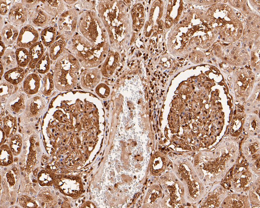 Immunohistochemical analysis of paraffin-embedded human kidney tissue with Rabbit anti-Ubiquitin antibody (ER31212) at 1/1,000 dilution.<br />
<br />
The section was pre-treated using heat mediated antigen retrieval with sodium citrate buffer (pH 6.0) for 2 minutes. The tissues were blocked in 1% BSA for 20 minutes at room temperature, washed with ddH2O and PBS, and then probed with the primary antibody (ER31212) at 1/1,000 dilution for 1 hour at room temperature. The detection was performed using an HRP conjugated compact polymer system. DAB was used as the chromogen. Tissues were counterstained with hematoxylin and mounted with DPX.
