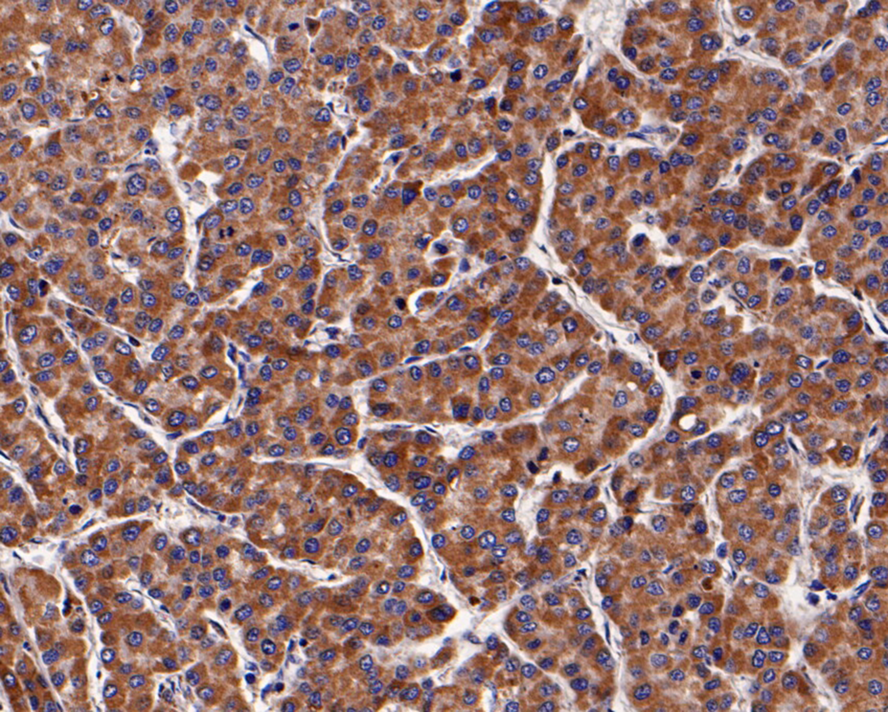 Immunohistochemical analysis of paraffin-embedded human liver cancer tissue with Rabbit anti-Pannexin 2 antibody (ER1901-05) at 1/400 dilution.<br />
<br />
The section was pre-treated using heat mediated antigen retrieval with Tris-EDTA buffer (pH 9.0) for 20 minutes. The tissues were blocked in 1% BSA for 20 minutes at room temperature, washed with ddH2O and PBS, and then probed with the primary antibody (ER1901-05) at 1/400 dilution for 1 hour at room temperature. The detection was performed using an HRP conjugated compact polymer system. DAB was used as the chromogen. Tissues were counterstained with hematoxylin and mounted with DPX.