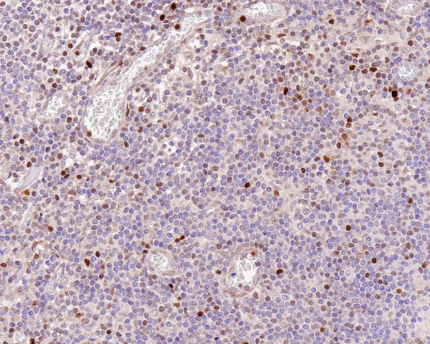 Immunohistochemical analysis of paraffin-embedded human lymph nodes tissue with Rabbit anti-T-bet antibody (ER1802-65) at 1/500 dilution.<br />
<br />
The section was pre-treated using heat mediated antigen retrieval with sodium citrate buffer (pH 6.0) for 2 minutes. The tissues were blocked in 1% BSA for 20 minutes at room temperature, washed with ddH2O and PBS, and then probed with the primary antibody (ER1802-65) at 1/500 dilution for 1 hour at room temperature. The detection was performed using an HRP conjugated compact polymer system. DAB was used as the chromogen. Tissues were counterstained with hematoxylin and mounted with DPX.