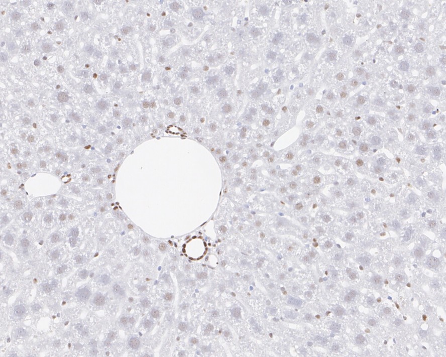 Immunohistochemical analysis of paraffin-embedded human breast carcinoma tissue with Rabbit anti-c-Jun antibody (ET1608-3) at 1/1,000 dilution.<br />
<br />
The section was pre-treated using heat mediated antigen retrieval with sodium citrate buffer (pH 6.0) for 2 minutes. The tissues were blocked in 1% BSA for 20 minutes at room temperature, washed with ddH2O and PBS, and then probed with the primary antibody (ET1608-3) at 1/1,000 dilution for 1 hour at room temperature. The detection was performed using an HRP conjugated compact polymer system. DAB was used as the chromogen. Tissues were counterstained with hematoxylin and mounted with DPX.