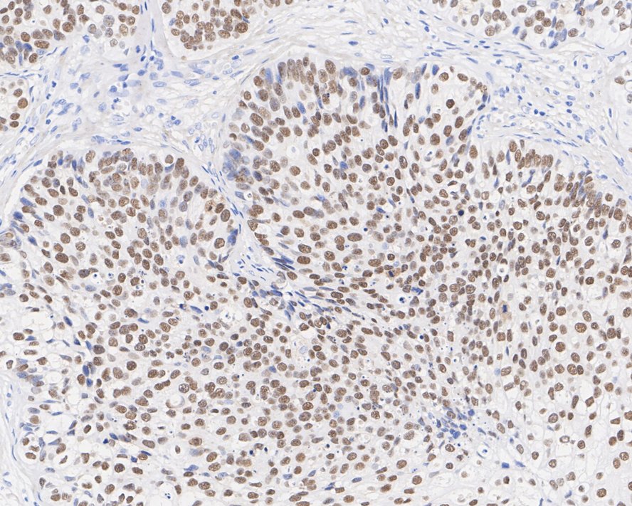 Immunohistochemical analysis of paraffin-embedded human urethral carcinoma tissue with Rabbit anti-FOXA1 antibody (ET1702-89) at 1/100 dilution.<br />
<br />
The section was pre-treated using heat mediated antigen retrieval with sodium citrate buffer (pH 6.0) for 2 minutes. The tissues were blocked in 1% BSA for 20 minutes at room temperature, washed with ddH2O and PBS, and then probed with the primary antibody (ET1702-89) at 1/100 dilution for 1 hour at room temperature. The detection was performed using an HRP conjugated compact polymer system. DAB was used as the chromogen. Tissues were counterstained with hematoxylin and mounted with DPX.