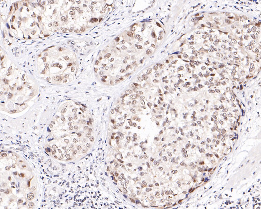 Immunohistochemical analysis of paraffin-embedded human bladder carcinoma tissue with Rabbit anti-TATA binding protein TBP antibody (HA500518) at 1/2,000 dilution.<br />
<br />
The section was pre-treated using heat mediated antigen retrieval with sodium citrate buffer (pH 6.0) for 2 minutes. The tissues were blocked in 1% BSA for 20 minutes at room temperature, washed with ddH2O and PBS, and then probed with the primary antibody (HA500518) at 1/2,000 dilution for 1 hour at room temperature. The detection was performed using an HRP conjugated compact polymer system. DAB was used as the chromogen. Tissues were counterstained with hematoxylin and mounted with DPX.
