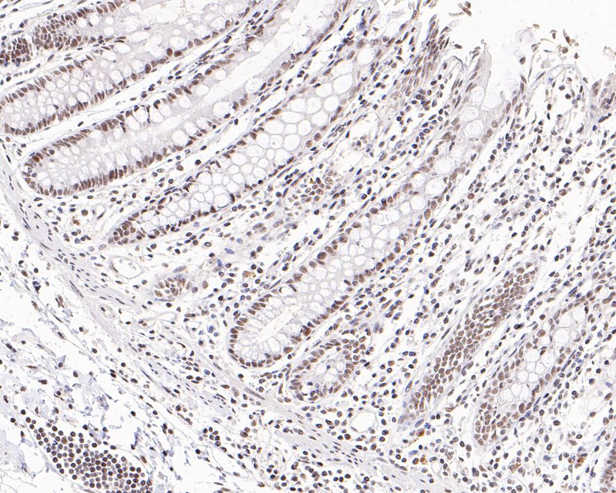 Immunohistochemical analysis of paraffin-embedded human colon tissue with Rabbit anti-TATA binding protein TBP antibody (HA500518) at 1/2,000 dilution.<br />
<br />
The section was pre-treated using heat mediated antigen retrieval with sodium citrate buffer (pH 6.0) for 2 minutes. The tissues were blocked in 1% BSA for 20 minutes at room temperature, washed with ddH2O and PBS, and then probed with the primary antibody (HA500518) at 1/2,000 dilution for 1 hour at room temperature. The detection was performed using an HRP conjugated compact polymer system. DAB was used as the chromogen. Tissues were counterstained with hematoxylin and mounted with DPX.