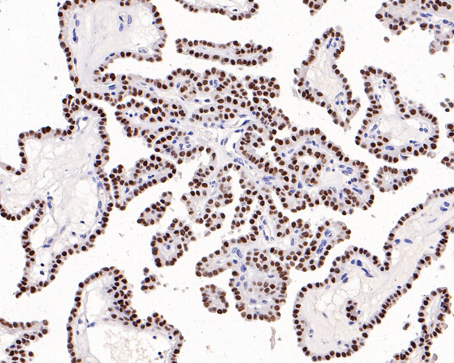 Immunohistochemical analysis of paraffin-embedded human ovary carcinoma tissue with Rabbit anti-PAX8 antibody (HA720112) at 1/1,000 dilution.<br />
<br />
The section was pre-treated using heat mediated antigen retrieval with sodium citrate buffer (pH 6.0) for 2 minutes. The tissues were blocked in 1% BSA for 20 minutes at room temperature, washed with ddH2O and PBS, and then probed with the primary antibody (HA720112) at 1/1,000 dilution for 1 hour at room temperature. The detection was performed using an HRP conjugated compact polymer system. DAB was used as the chromogen. Tissues were counterstained with hematoxylin and mounted with DPX.