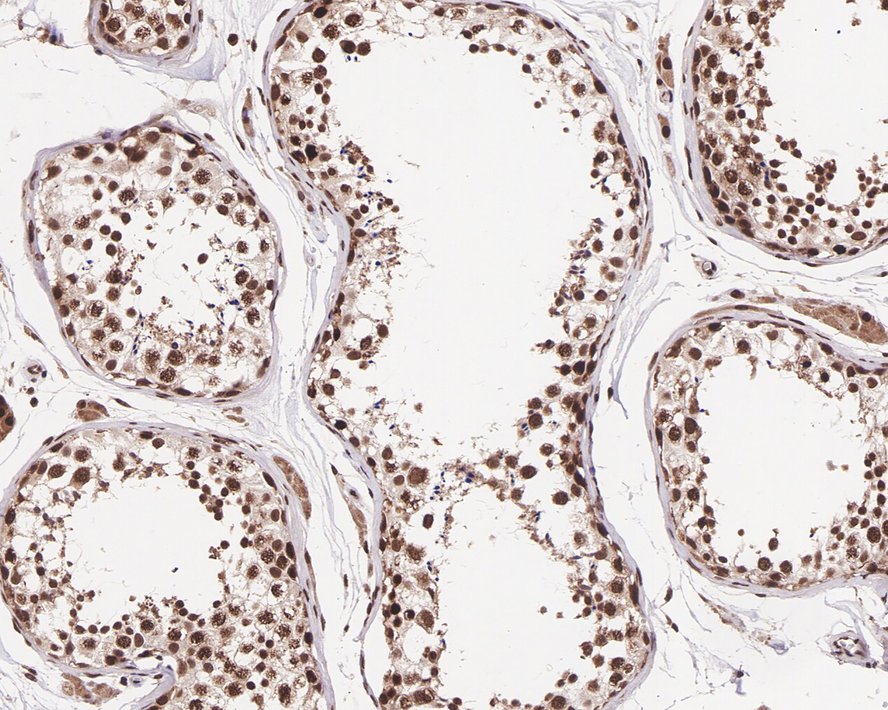Immunohistochemical analysis of paraffin-embedded human testis carcinoma tissue with Mouse anti-Cyclin E2 antibody (M0407-15) at 1/200 dilution.<br />
<br />
The section was pre-treated using heat mediated antigen retrieval with sodium citrate buffer (pH 6.0) for 2 minutes. The tissues were blocked in 1% BSA for 20 minutes at room temperature, washed with ddH2O and PBS, and then probed with the primary antibody (M0407-15) at 1/200 dilution for 1 hour at room temperature. The detection was performed using an HRP conjugated compact polymer system. DAB was used as the chromogen. Tissues were counterstained with hematoxylin and mounted with DPX.