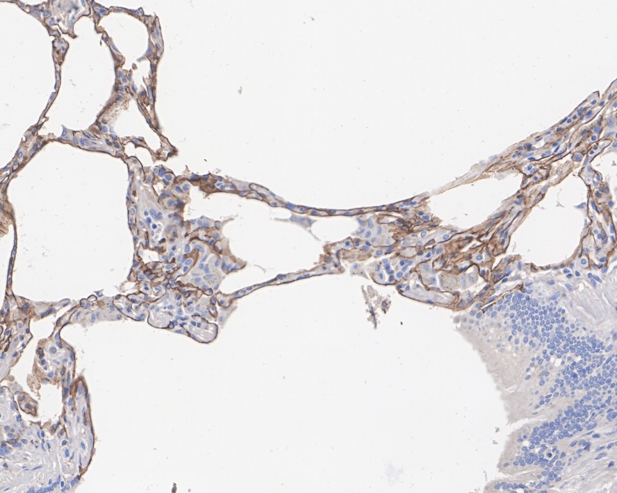 Immunohistochemical analysis of paraffin-embedded human lung tissue with Rabbit anti-RAGE antibody (ET1702-27) at 1/200 dilution.<br />
<br />
The section was pre-treated using heat mediated antigen retrieval with Tris-EDTA buffer (pH 9.0) for 20 minutes. The tissues were blocked in 1% BSA for 20 minutes at room temperature, washed with ddH2O and PBS, and then probed with the primary antibody (ET1702-27) at 1/200 dilution for 1 hour at room temperature. The detection was performed using an HRP conjugated compact polymer system. DAB was used as the chromogen. Tissues were counterstained with hematoxylin and mounted with DPX.