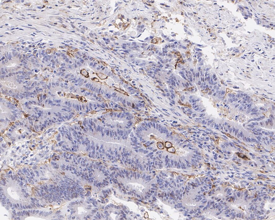 Immunohistochemical analysis of paraffin-embedded human colon cancer tissue with Rabbit anti-CD11c antibody (ET1606-19) at 1/800 dilution.<br />
<br />
The section was pre-treated using heat mediated antigen retrieval with Tris-EDTA buffer (pH 9.0) for 20 minutes. The tissues were blocked in 1% BSA for 20 minutes at room temperature, washed with ddH2O and PBS, and then probed with the primary antibody (ET1606-19) at 1/800 dilution for 1 hour at room temperature. The detection was performed using an HRP conjugated compact polymer system. DAB was used as the chromogen. Tissues were counterstained with hematoxylin and mounted with DPX.
