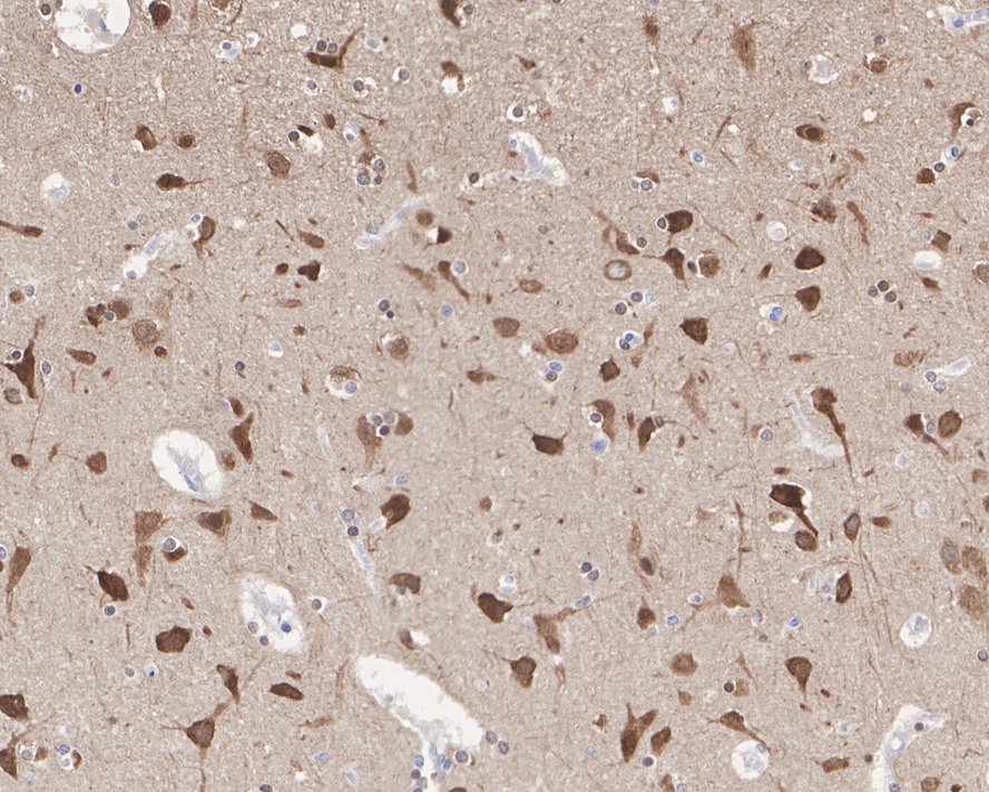 Immunohistochemical analysis of paraffin-embedded human brain tissue with Rabbit anti-Phospho-Tau(T231) antibody (ET1610-31) at 1/1,000 dilution.<br />
<br />
The section was pre-treated using heat mediated antigen retrieval with Tris-EDTA buffer (pH 9.0) for 20 minutes. The tissues were blocked in 1% BSA for 20 minutes at room temperature, washed with ddH2O and PBS, and then probed with the primary antibody (ET1610-31) at 1/1,000 dilution for 1 hour at room temperature. The detection was performed using an HRP conjugated compact polymer system. DAB was used as the chromogen. Tissues were counterstained with hematoxylin and mounted with DPX.