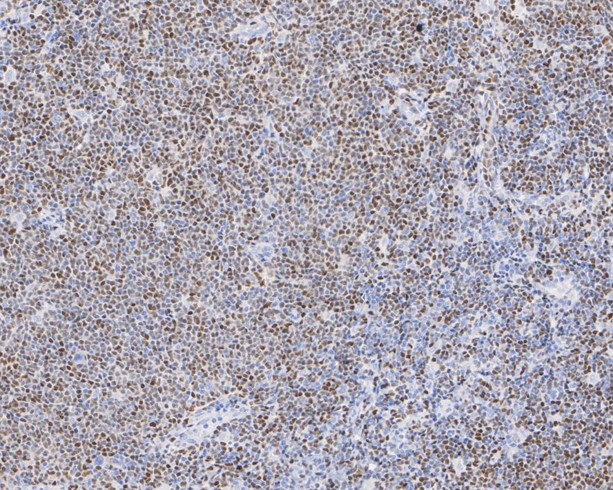 Immunohistochemical analysis of paraffin-embedded human mantle cell lymphoma tissue with Rabbit anti-SOX11 antibody (ET1612-76) at 1/200 dilution.<br />
<br />
The section was pre-treated using heat mediated antigen retrieval with sodium citrate buffer (pH 6.0) for 2 minutes. The tissues were blocked in 1% BSA for 20 minutes at room temperature, washed with ddH2O and PBS, and then probed with the primary antibody (ET1612-76) at 1/200 dilution for 1 hour at room temperature. The detection was performed using an HRP conjugated compact polymer system. DAB was used as the chromogen. Tissues were counterstained with hematoxylin and mounted with DPX.
