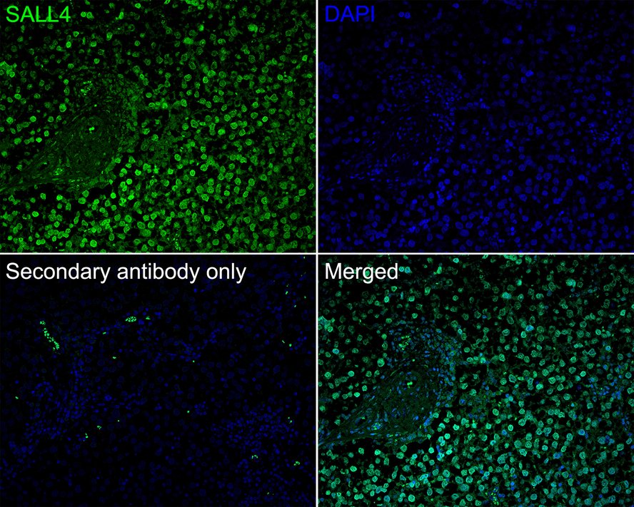 Immunofluorescence analysis of paraffin-embedded human seminoma tissue labeling Sall4 with Mouse anti-Sall4 antibody (HA601042) at 1/200 dilution.<br />
<br />
The section was pre-treated using heat mediated antigen retrieval with sodium citrate buffer (pH 6.0) for 2 minutes. The tissues were blocked in 10% negative goat serum for 1 hour at room temperature, washed with PBS, and then probed with the primary antibody (HA601042, green) at 1/200 dilution overnight at 4 ℃, washed with PBS. Goat Anti-Mouse IgG H&L (iFluor™ 488, HA1125) was used as the secondary antibody at 1/1,000 dilution. Nuclei were counterstained with DAPI (blue).