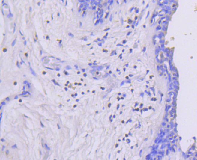 Immunohistochemical analysis of paraffin-embedded human breast carcinoma tissue using anti-Phospho-MEK1 (S218 + S222) antibody. The section was pre-treated using heat mediated antigen retrieval with Tris-EDTA buffer (pH 8.0-8.4) for 20 minutes.The tissues were blocked in 5% BSA for 30 minutes at room temperature, washed with ddH2O and PBS, and then probed with the primary antibody (ET1609-50, 1/50) for 30 minutes at room temperature. The detection was performed using an HRP conjugated compact polymer system. DAB was used as the chromogen. Tissues were counterstained with hematoxylin and mounted with DPX.