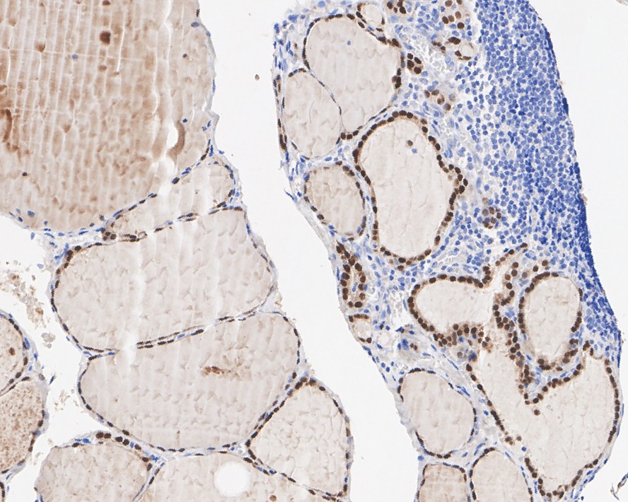 Immunohistochemical analysis of paraffin-embedded human thyroid tissue with Mouse anti-PAX8 antibody (EM1701-81) at 1/2,000 dilution.<br />
<br />
The section was pre-treated using heat mediated antigen retrieval with sodium citrate buffer (pH 6.0) for 2 minutes. The tissues were blocked in 1% BSA for 20 minutes at room temperature, washed with ddH2O and PBS, and then probed with the primary antibody (EM1701-81) at 1/2,000 dilution for 1 hour at room temperature. The detection was performed using an HRP conjugated compact polymer system. DAB was used as the chromogen. Tissues were counterstained with hematoxylin and mounted with DPX.