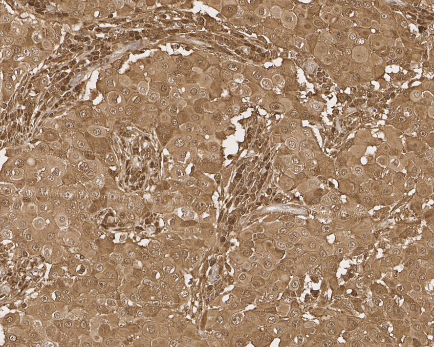 Immunohistochemical analysis of paraffin-embedded human breast cancer tissue with Mouse anti-STAT1 antibody (M1407-1) at 1/1,000 dilution.<br />
<br />
The section was pre-treated using heat mediated antigen retrieval with sodium citrate buffer (pH 6.0) for 2 minutes. The tissues were blocked in 1% BSA for 20 minutes at room temperature, washed with ddH2O and PBS, and then probed with the primary antibody (M1407-1) at 1/1,000 dilution for 1 hour at room temperature. The detection was performed using an HRP conjugated compact polymer system. DAB was used as the chromogen. Tissues were counterstained with hematoxylin and mounted with DPX.