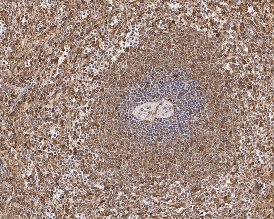 Immunohistochemical analysis of paraffin-embedded human spleen tissue with Mouse anti-STAT1 antibody (M1407-1) at 1/1,000 dilution.<br />
<br />
The section was pre-treated using heat mediated antigen retrieval with sodium citrate buffer (pH 6.0) for 2 minutes. The tissues were blocked in 1% BSA for 20 minutes at room temperature, washed with ddH2O and PBS, and then probed with the primary antibody (M1407-1) at 1/1,000 dilution for 1 hour at room temperature. The detection was performed using an HRP conjugated compact polymer system. DAB was used as the chromogen. Tissues were counterstained with hematoxylin and mounted with DPX.