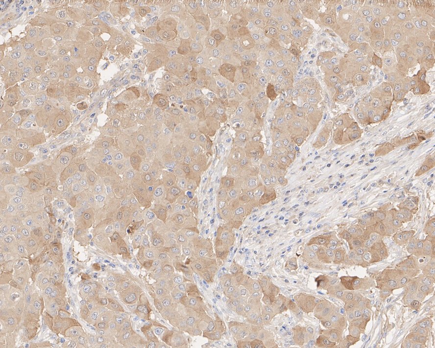Immunohistochemical analysis of paraffin-embedded human breast cancer tissue with Rabbit anti-14-3-3 gamma antibody (ET1612-9) at 1/1,000 dilution.<br />
<br />
The section was pre-treated using heat mediated antigen retrieval with Tris-EDTA buffer (pH 9.0) for 20 minutes. The tissues were blocked in 1% BSA for 20 minutes at room temperature, washed with ddH2O and PBS, and then probed with the primary antibody (ET1612-9) at 1/1,000 dilution for 1 hour at room temperature. The detection was performed using an HRP conjugated compact polymer system. DAB was used as the chromogen. Tissues were counterstained with hematoxylin and mounted with DPX.