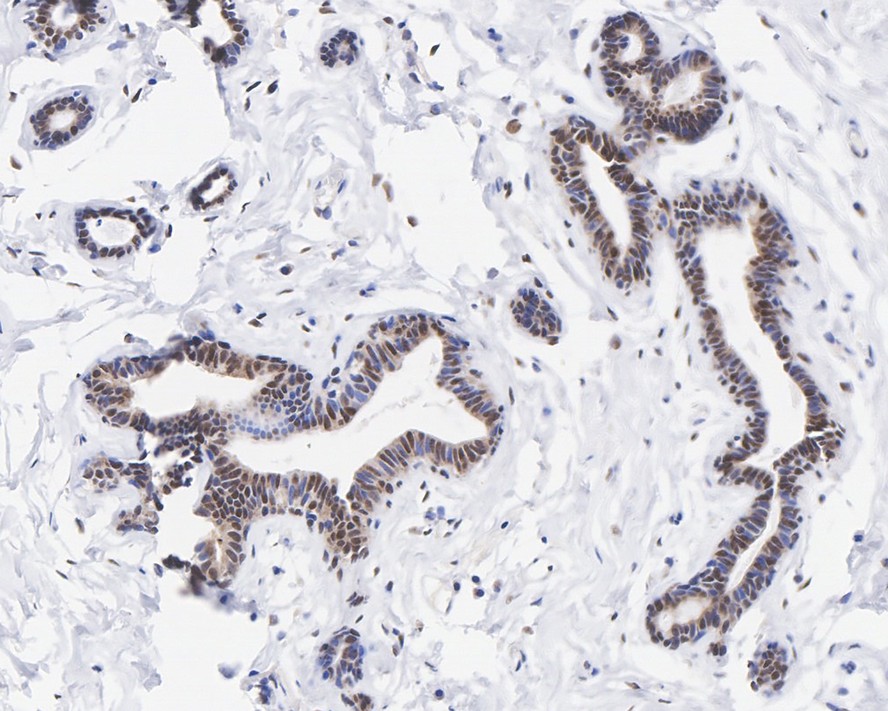 Immunohistochemical analysis of paraffin-embedded human breast tissue with Rabbit anti-JunD antibody (ET1612-92) at 1/500 dilution.<br />
<br />
The section was pre-treated using heat mediated antigen retrieval with sodium citrate buffer (pH 6.0) for 2 minutes. The tissues were blocked in 1% BSA for 20 minutes at room temperature, washed with ddH2O and PBS, and then probed with the primary antibody (ET1612-92) at 1/500 dilution for 1 hour at room temperature. The detection was performed using an HRP conjugated compact polymer system. DAB was used as the chromogen. Tissues were counterstained with hematoxylin and mounted with DPX.