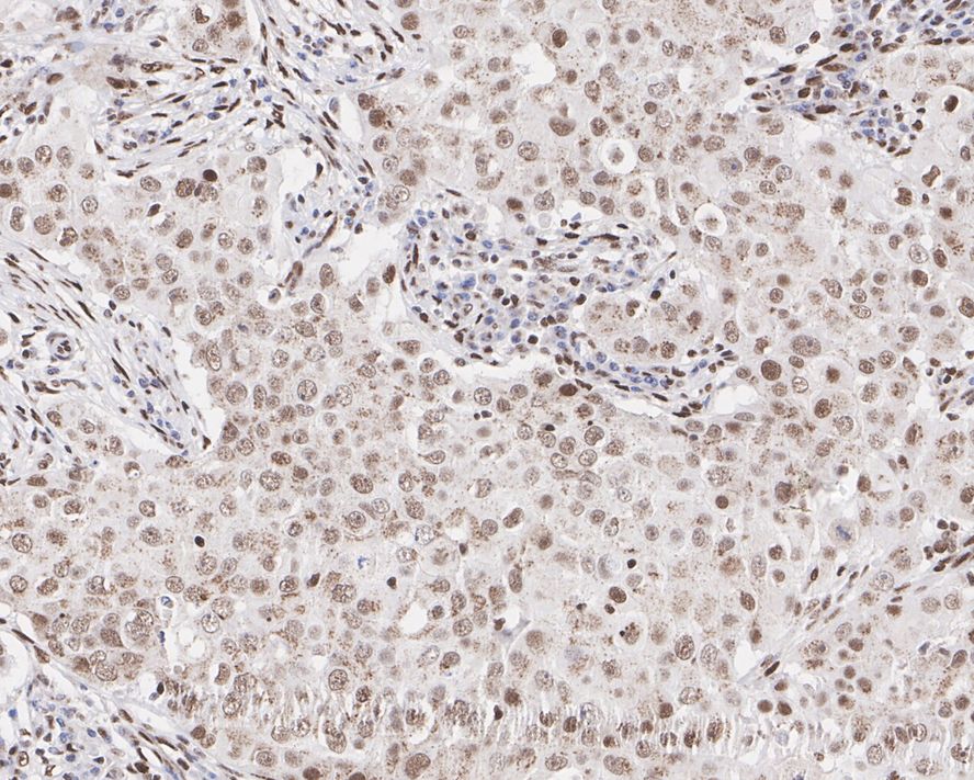 Immunohistochemical analysis of paraffin-embedded human breast cancer tissue with Rabbit anti-JunD antibody (ET1612-92) at 1/500 dilution.<br />
<br />
The section was pre-treated using heat mediated antigen retrieval with sodium citrate buffer (pH 6.0) for 2 minutes. The tissues were blocked in 1% BSA for 20 minutes at room temperature, washed with ddH2O and PBS, and then probed with the primary antibody (ET1612-92) at 1/500 dilution for 1 hour at room temperature. The detection was performed using an HRP conjugated compact polymer system. DAB was used as the chromogen. Tissues were counterstained with hematoxylin and mounted with DPX.