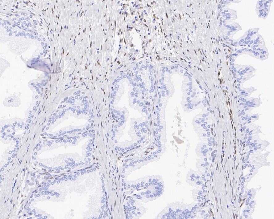 Immunohistochemical analysis of paraffin-embedded human prostate tissue with Rabbit anti-FGF2 antibody (ET1703-18) at 1/1,000 dilution.<br />
<br />
The section was pre-treated using heat mediated antigen retrieval with sodium citrate buffer (pH 6.0) for 2 minutes. The tissues were blocked in 1% BSA for 20 minutes at room temperature, washed with ddH2O and PBS, and then probed with the primary antibody (ET1703-18) at 1/1,000 dilution for 1 hour at room temperature. The detection was performed using an HRP conjugated compact polymer system. DAB was used as the chromogen. Tissues were counterstained with hematoxylin and mounted with DPX.