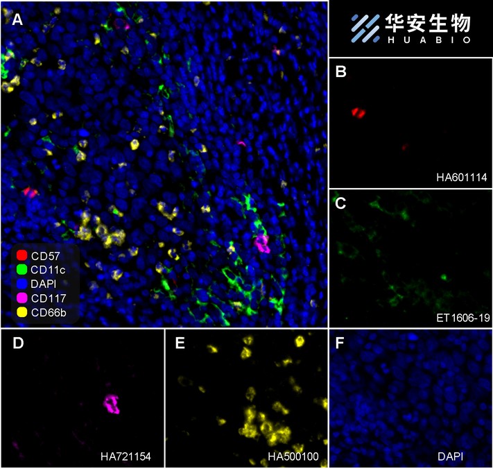 Fluorescence multiplex immunohistochemical analysis of the human cervical cancer (Formalin/PFA-fixed paraffin-embedded sections). Panel A: the merged image of anti-CD57 (HA601114, red), anti-CD11c (ET1606-19, green), anti-CD117 (HA21154, magenta) and anti-CD66b (HA500100, yellow) on human cervical cancer. Panel B: anti- CD57 stained on NKT cells. Panel C: anti-CD11c stained on dendritic cells. Panel D: anti-CD117 stained on mast cells. Panel E: anti-CD66b stained on neutrophils. HRP Conjugated UltraPolymer Goat Polyclonal Antibody HA1119/HA1120 was used as a secondary antibody. The immunostaining was performed with the Sequential Immuno-staining Kit (IRISKit™MH010101, www.luminiris.cn). The section was incubated in four rounds of staining: in the order of HA601114 (1/500 dilution), ET1606-19 (1/1,000 dilution), HA721154 (1/1,000 dilution), and HA500100 (1/1,000 dilution) for 20 mins at room temperature. Each round was followed by a separate fluorescent tyramide signal amplification system. Heat mediated antigen retrieval with Tris-EDTA buffer (pH 9.0) for 30 mins at 95C. DAPI (blue) was used as a nuclear counter stain. Image acquisition was performed with Olympus VS200 Slide Scanner.