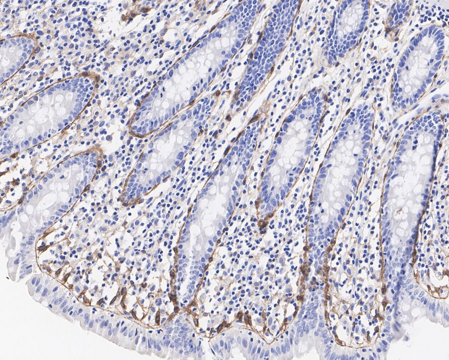 Immunohistochemical analysis of paraffin-embedded human colon tissue with Rabbit anti-PDGFR alpha antibody (ET1702-49) at 1/500 dilution.<br />
<br />
The section was pre-treated using heat mediated antigen retrieval with Tris-EDTA buffer (pH 9.0) for 20 minutes. The tissues were blocked in 1% BSA for 20 minutes at room temperature, washed with ddH2O and PBS, and then probed with the primary antibody (ET1702-49) at 1/500 dilution for 1 hour at room temperature. The detection was performed using an HRP conjugated compact polymer system. DAB was used as the chromogen. Tissues were counterstained with hematoxylin and mounted with DPX.