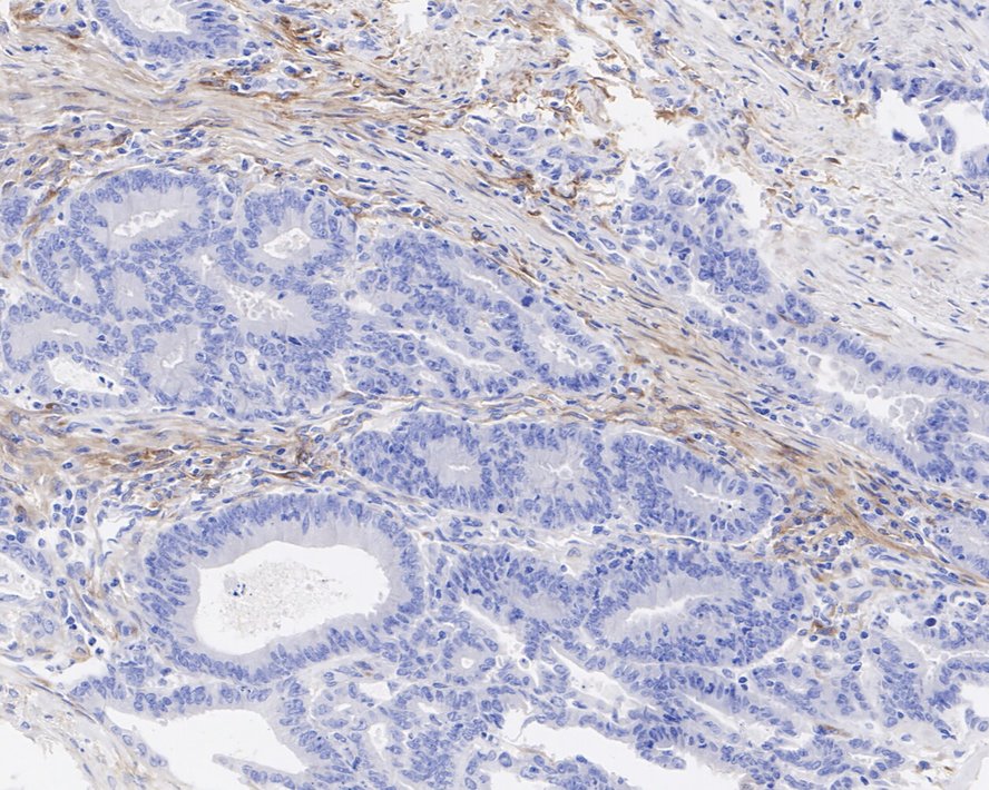 Immunohistochemical analysis of paraffin-embedded human colon cancer tissue with Rabbit anti-PDGFR alpha antibody (ET1702-49) at 1/500 dilution.<br />
<br />
The section was pre-treated using heat mediated antigen retrieval with Tris-EDTA buffer (pH 9.0) for 20 minutes. The tissues were blocked in 1% BSA for 20 minutes at room temperature, washed with ddH2O and PBS, and then probed with the primary antibody (ET1702-49) at 1/500 dilution for 1 hour at room temperature. The detection was performed using an HRP conjugated compact polymer system. DAB was used as the chromogen. Tissues were counterstained with hematoxylin and mounted with DPX.