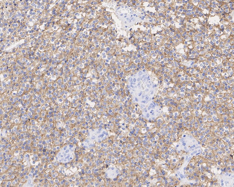 Immunohistochemical analysis of paraffin-embedded human glioblastoma tissue with Rabbit anti-PDGFR alpha antibody (ET1702-49) at 1/500 dilution.<br />
<br />
The section was pre-treated using heat mediated antigen retrieval with Tris-EDTA buffer (pH 9.0) for 20 minutes. The tissues were blocked in 1% BSA for 20 minutes at room temperature, washed with ddH2O and PBS, and then probed with the primary antibody (ET1702-49) at 1/500 dilution for 1 hour at room temperature. The detection was performed using an HRP conjugated compact polymer system. DAB was used as the chromogen. Tissues were counterstained with hematoxylin and mounted with DPX.